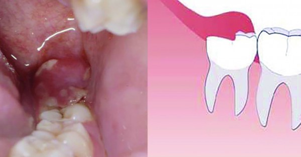 نهفتگی دندان چیست؟