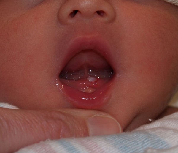 مشکلات مربوط به بیرون زدن دندانها در کودکان