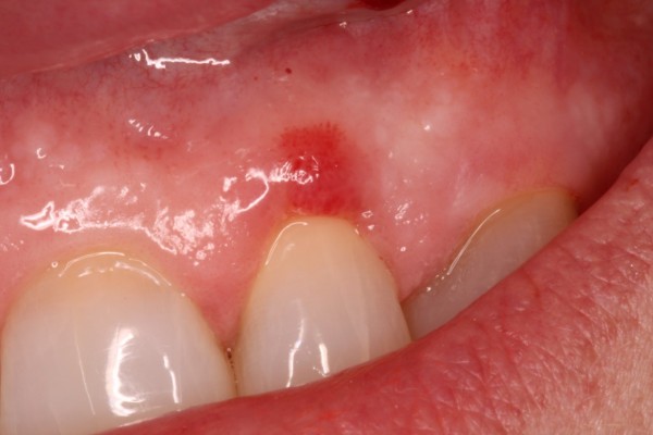 خطرات عفونت و آبسه دندان
