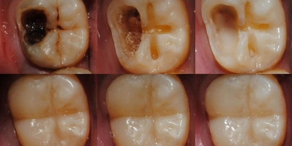 پیشگیری و درمان مشکلات شایع دهان و دندان