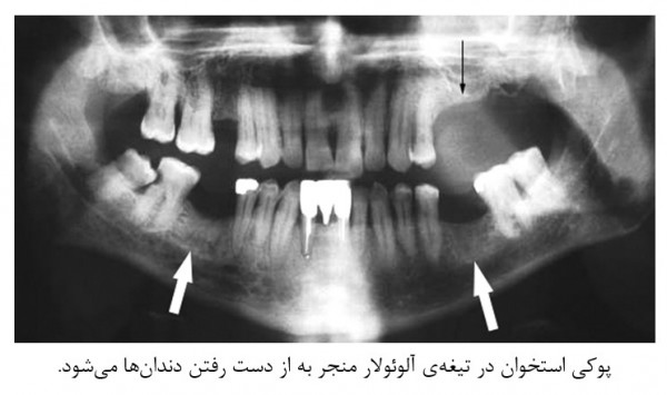 پوکی استخوان و بیماری‌های دهان و دندان