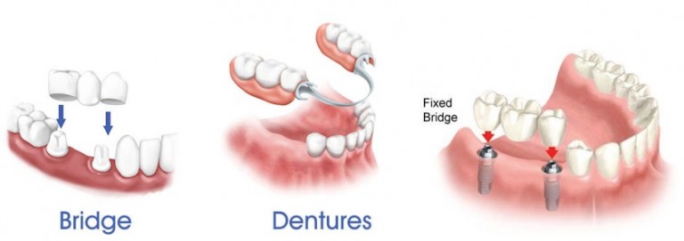 دندان مصنوعی یا دنچر
