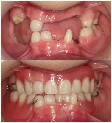 دندان مصنوعی یا دنچر