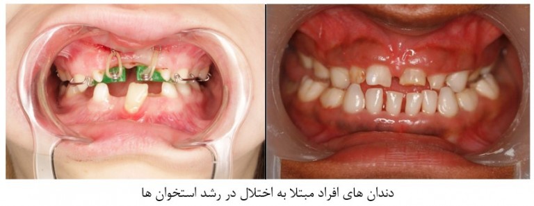 اختلالات رشد دندان در کودکان