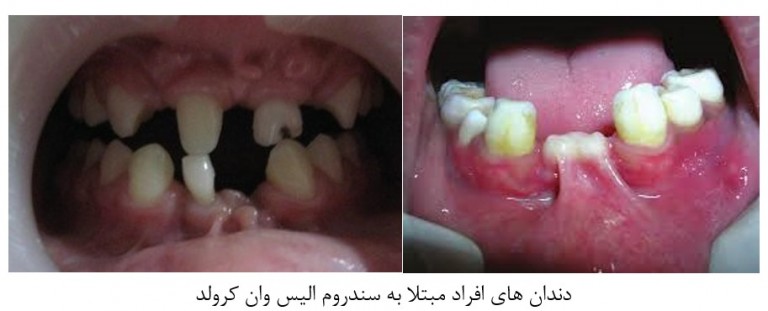 اختلالات رشد دندان در کودکان
