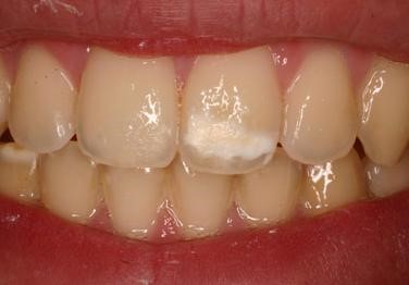 لکه سفید روی دندان