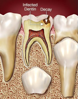 درمان ریشه (عصب کشی) دندان کودکان
