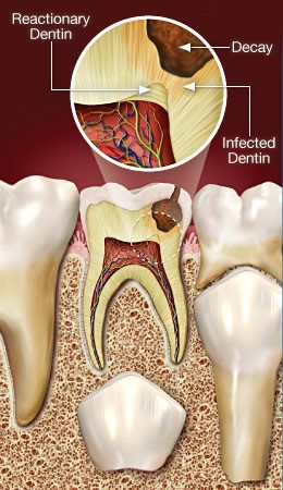 درمان ریشه (عصب کشی) دندان کودکان