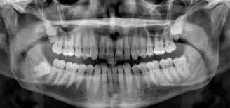 عکسبرداری و رادیوگرافی در دندانپزشکی